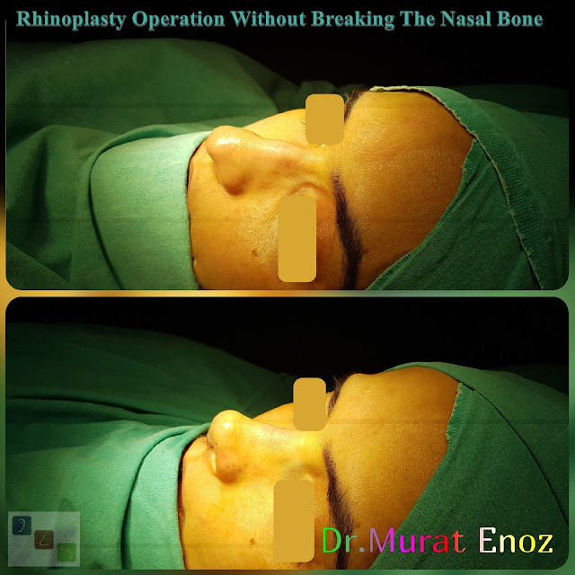 Rhinoplasty Without Breaking The Bone, Nose Job Without Bone Broken in Istanbul, Tip plasty, Micromotor Assisted Male Rhinoplasty Without Breaking The Bone,