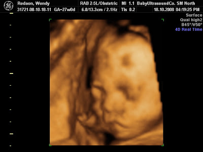 3d ultrasound pictures. 3d ultrasound pictures at 20