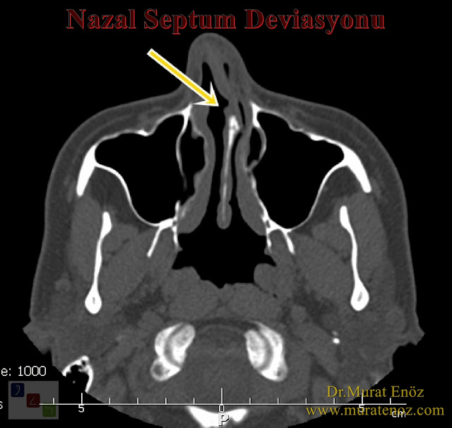 Bebeklerde nazal septum deviasyonu - Çocuklarda nazal septum deviasyonu - Yenidoğanlarda nazal septum deviasyonu tesi - Yenidoğanlarda Gray' in Strut Testi - Vajinal doğumla dünyaya gelen bebeklerde septum deviasyonu - Normal doğum ile doğan bebeklerde burunda kıkırdak eğriliği sıklığı - Nazal septum deviasyonu nedenleri - Anterior septal dislokasyon