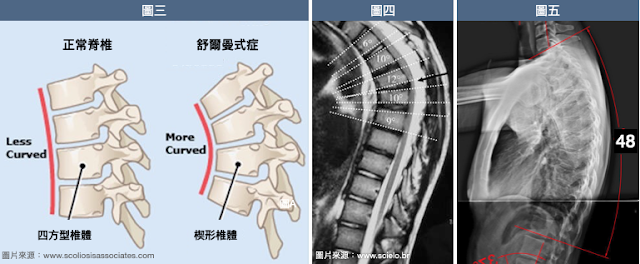 青少年駝背,舒爾曼氏駝背,駝背,Scheuermann's disease