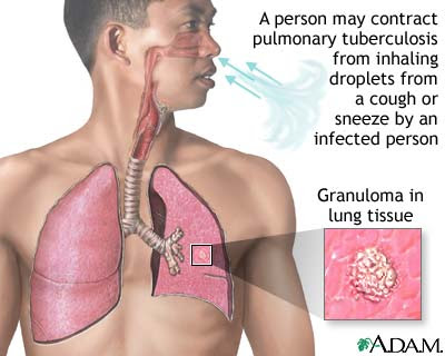 matarasakata: Mengapa Penyakit TBC susah disembuhkan?