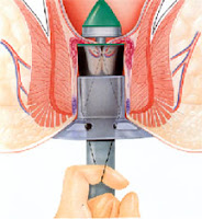 hemorroids removal pic