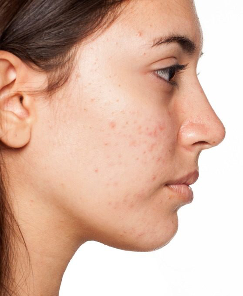  Here’s What’s Causing Acne on Every Part of Your Face