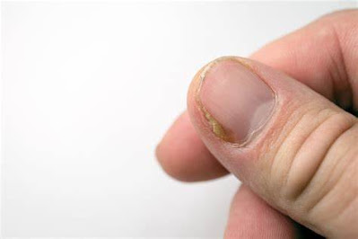 Nail Fungus 101 What it is and How it Develops