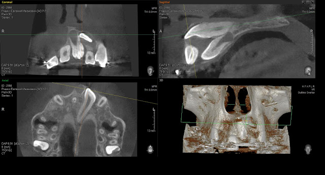 КТ верхней челюсти. сверхкомплектные зубы