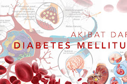 Jual Obat Herbal Diabetes Ampuh Di Kutai Kartanegara | WA : 0822-3442-9202