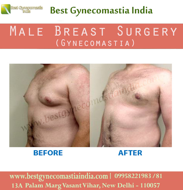 #gynecomastia, #gynecomastiacost, #malebreastreduction, #gynecomastiaclinic, #puffynipplesurgery, #malechestsurgery,  #specialistgynecomastiasurgeon, #southdelhi, #bestcost