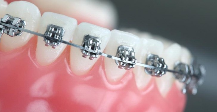  Harga  Pasang Kawat Gigi  Behel  Di Dokter  Ahli Gigi  Tahun Ini