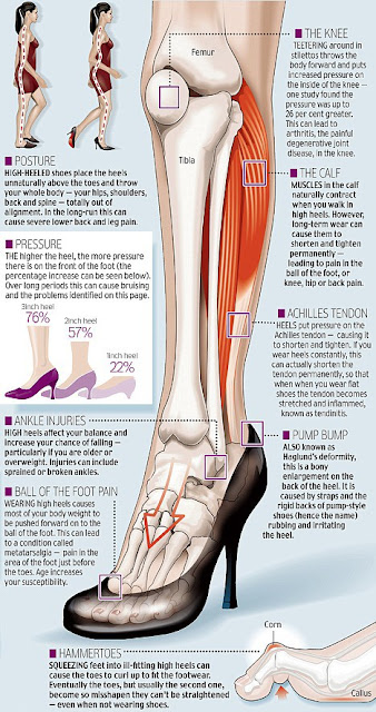 High heels put extra pressure on parts of our bodies that weren't meant to take it. This can cause serious foot damage.