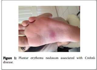 Plantar Erythema Nodosum 