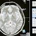 न्यूरोलॉजिकल विकारों को समझना और संबोधन के लिए तकनीक