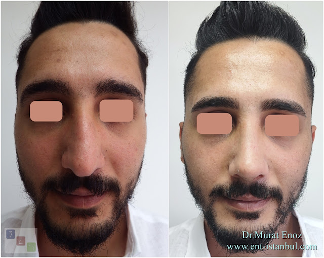Male rhinoplasty, Nose job for men, Natural nose aesthetic for men