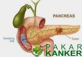 http://obattumorpankreasherbal.blogspot.com/2015/05/gejala-penyakit-tumor-pankreas.html