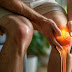  Understanding Knee Osteoarthritis and Its Physiotherapy Management