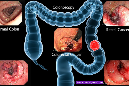 Những biểu hiện của ung thư Đại tràng