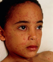 Chicken Pox Vaccine London