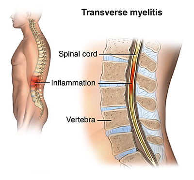 La mielitis transversa: el embotellamiento inflamatorio de la médula espinal