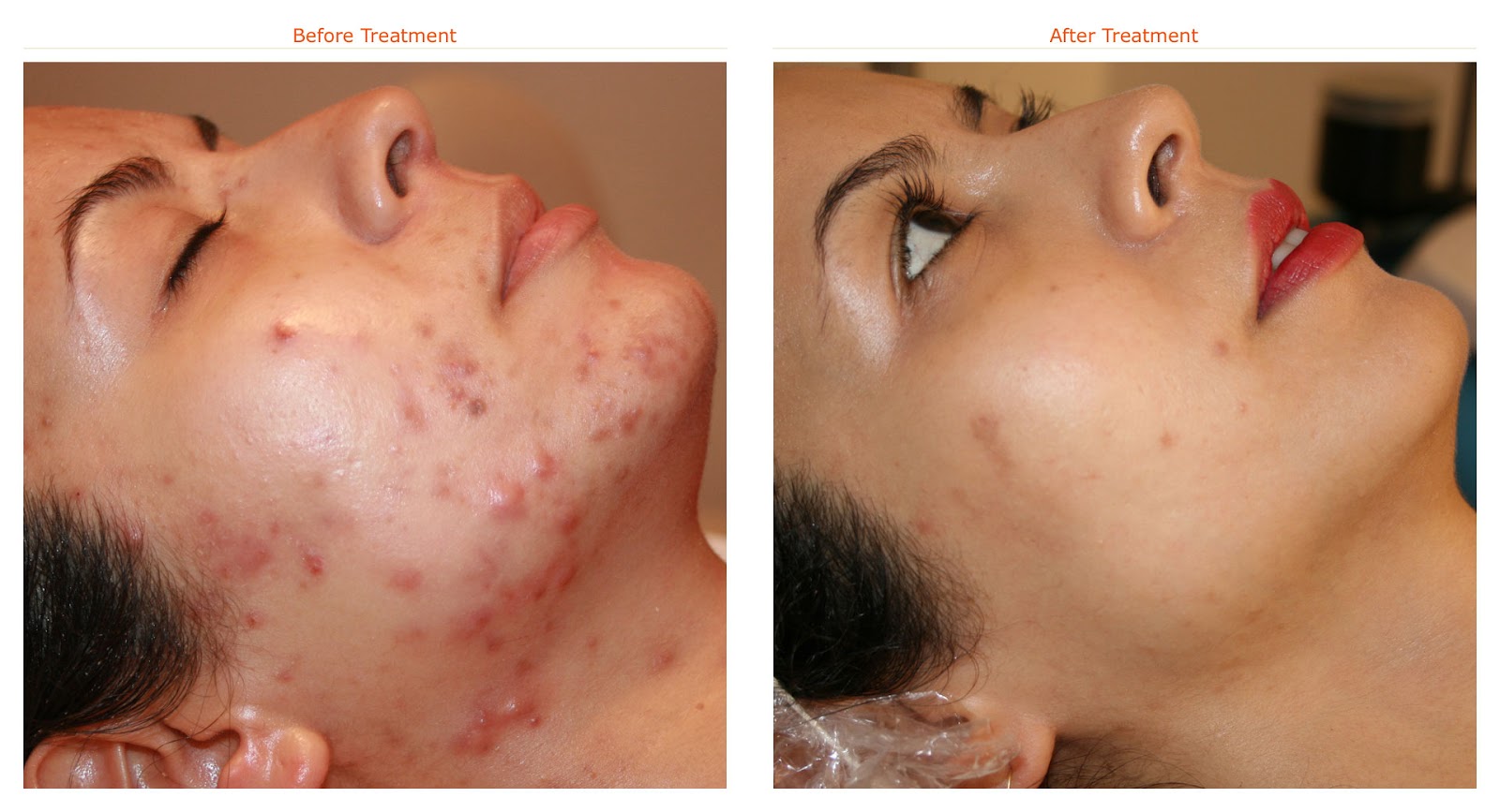 Best solution for acne, best treatment for acne dark spots ...