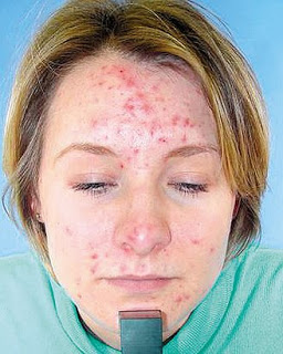 ADULT ACNE: CAUSES, SOLUTIONS | Gerovital H3 Romania