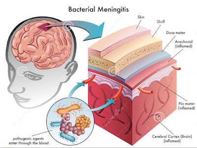 gejala-penyakit-meningitis