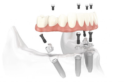 Cấy ghép implant khi mất toàn bộ răng cần quan tâm