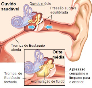 Cone Chinês - Limpeza de Ouvidos - Você sabia que a umidade é a principal causa da inflamação dos ouvidos?