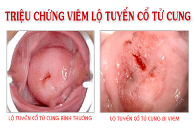 Triệu chứng viêm lộ tuyến cổ tử cung