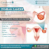  What are Ovarian cancer symptoms and its treatment?