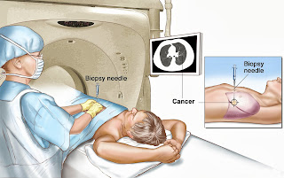 Types Of Most Common Cancer,Early Skin Cancer,Primary Liver Cancer,Most Common Cancer Types