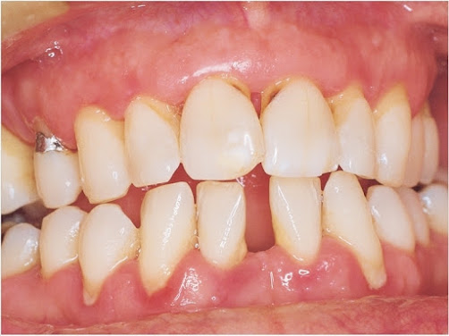 Periodontal Disease Therapeutics