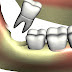 Nhổ răng khôn sau bao lâu thì được đánh răng ?