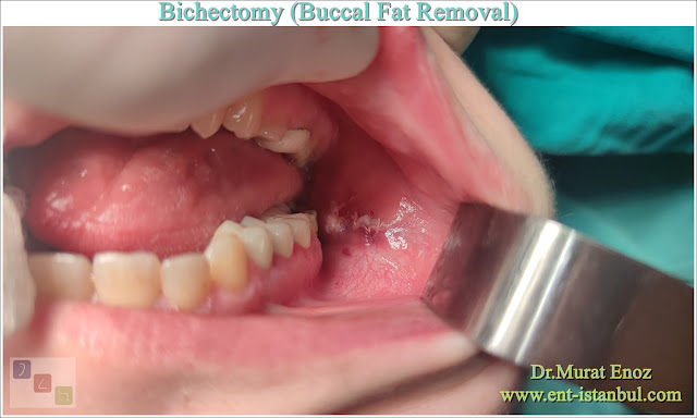 Bichectomy, Buccal Fat Removal, Buccal fat extraction, Hollywood cheek, Cheek Thinning Surgery, Cheek Fat Removal, Extended buccal lipectomy