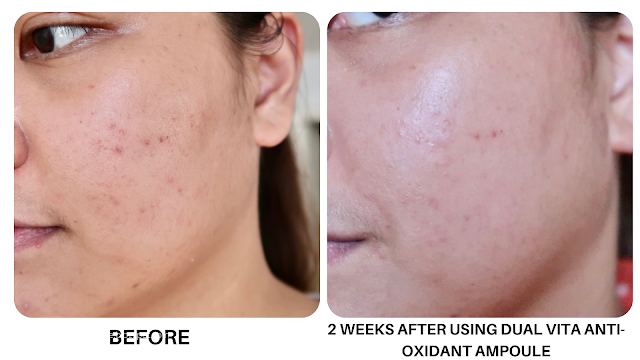 COMMONLABS VITAMIN C SKINCARE LIGHTENED MY MASKNE MARKS IN JUST TWO WEEKS review morena filipina beauty blog