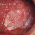 Can mouth cancer be prevented or found early?