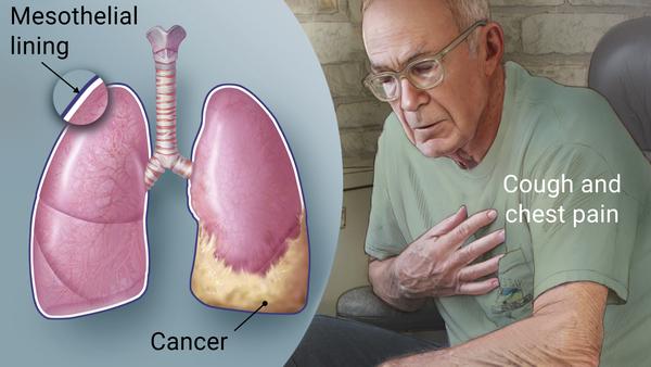 UNDERSTANDING MESOTHELIOMA  AS WELL AS THE SYMPTOMS AND TYPES