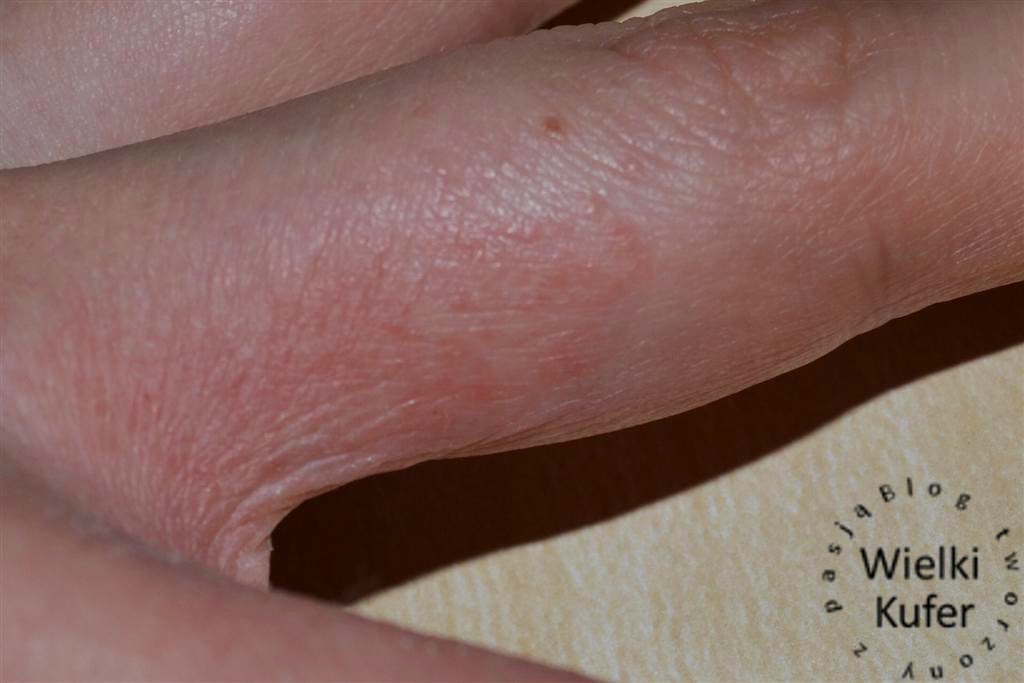 Alergia Kontaktowa Na Kosmetyki Zawierajace Sls Sles Itp Wielki Kufer