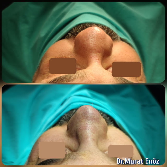 Nasal septal abscess, Foreign body reaction,Complicated Revision Rhinoplasty, Nose abscess, Tissue reaction due to industrial material in the nose, Total septal reconstruction