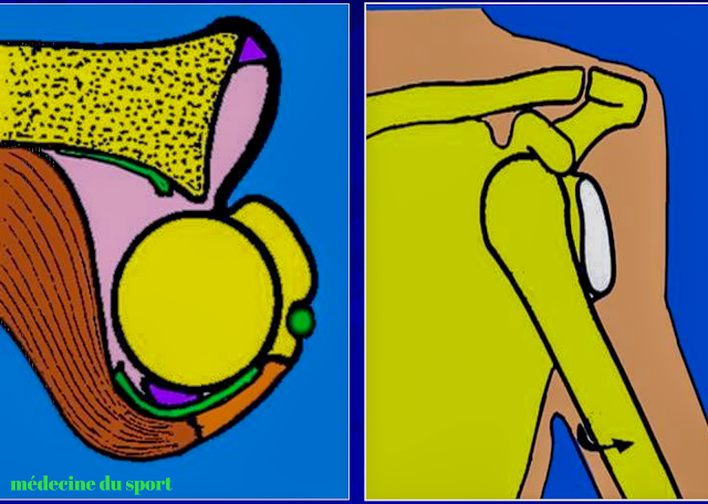 Les Luxations de l’épaule