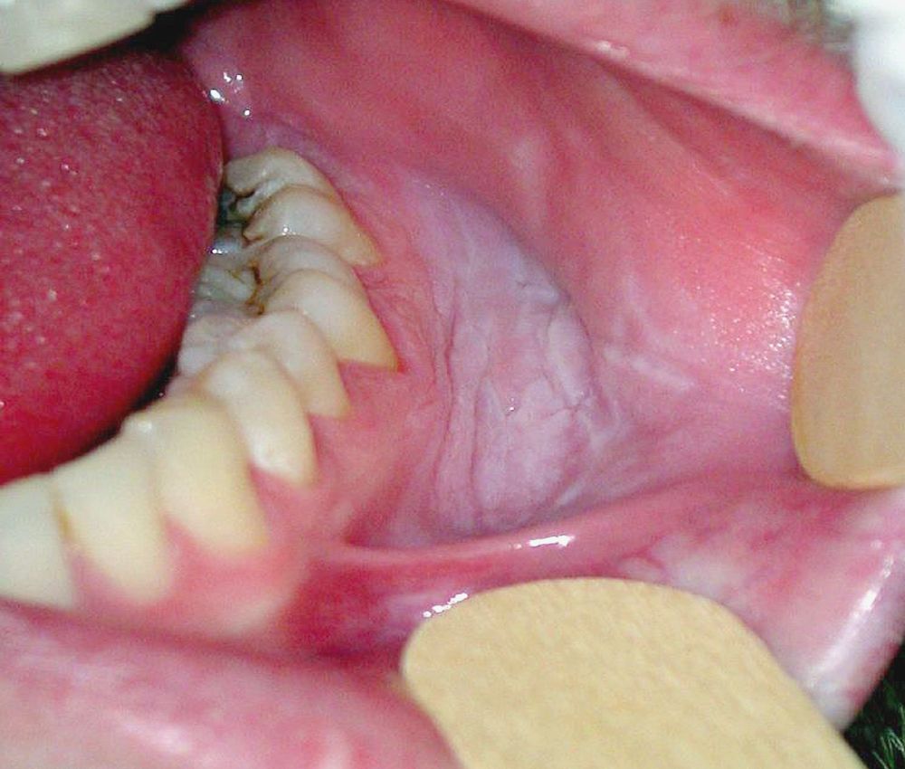 Oral Leukoplakia