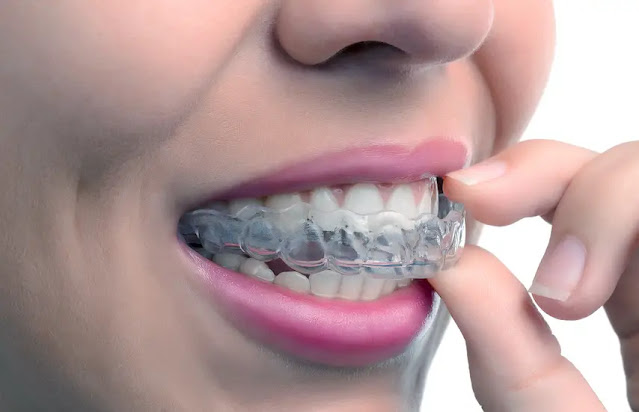 appareil dentaire amovible
