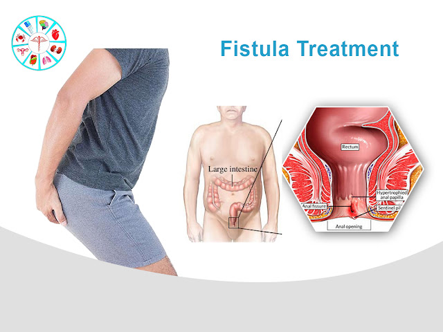 Fistula Treatment in Hyderabad