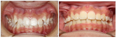 Kết quả trước và sau khi niềng răng khấp khểnh bằng khay niềng Invisalign