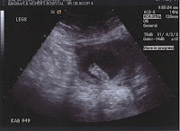 ultrasound feet