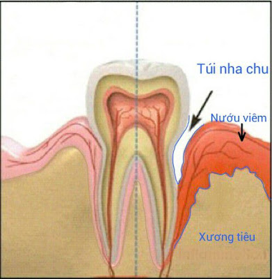 Tìm hiểu bệnh viêm nha chu có lây không-2