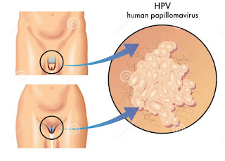 Anda harus tahu HPV kutil kelamin dan obatnya
