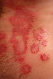 Successful Natural Herbal Cure of Psoriasis: Not Just Control But Complete Cure