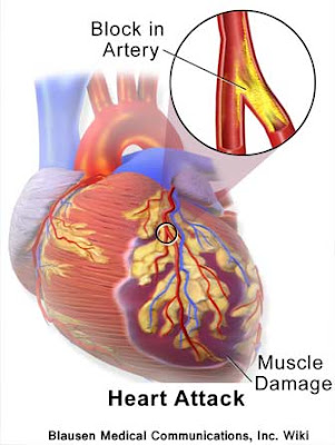 A myocardial infarction - Heart Attack