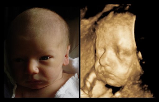 3d Ultrasounds1