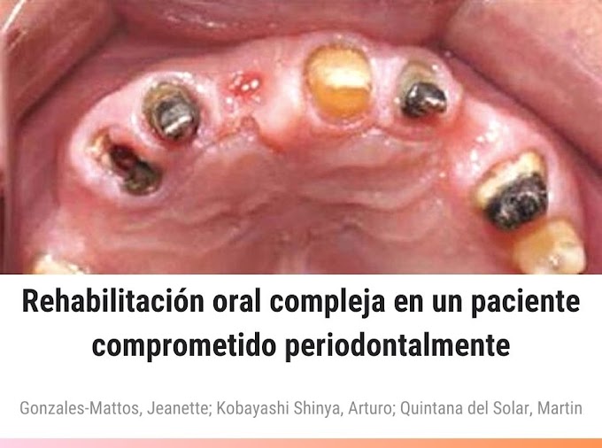 PDF: Rehabilitación oral compleja en un paciente comprometido periodontalmente. Reporte de caso clínico y seguimiento por 6 años