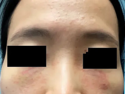 한관종-제거와-치료과정-후기